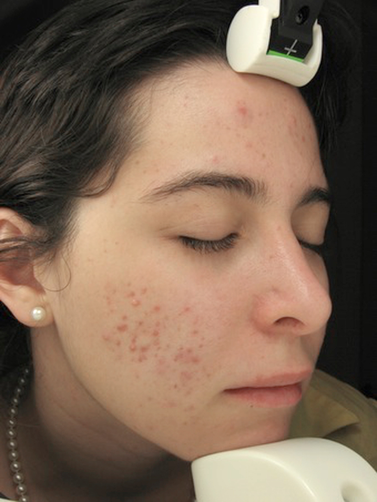 Acne patient before treatment Aesthetic Clinique health and beauty VIE Magazine