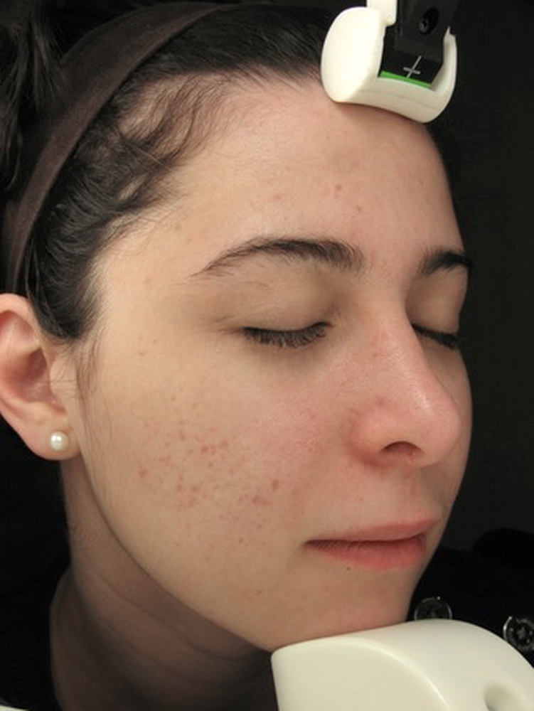 Acne patient after treatment Aesthetic Clinique health and beauty VIE magazine