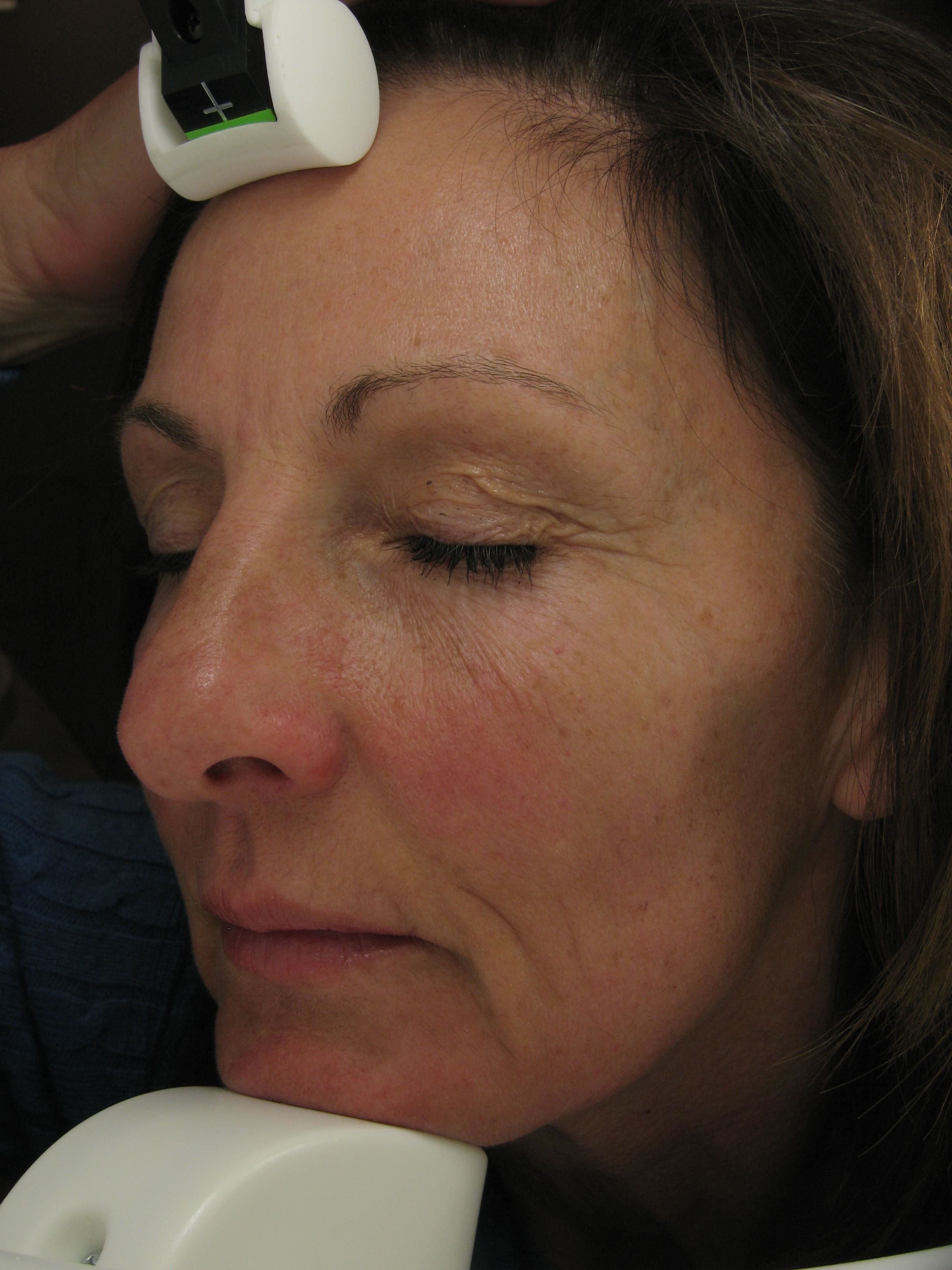 Left side before image of wrinkles; Aesthetic Clinique 