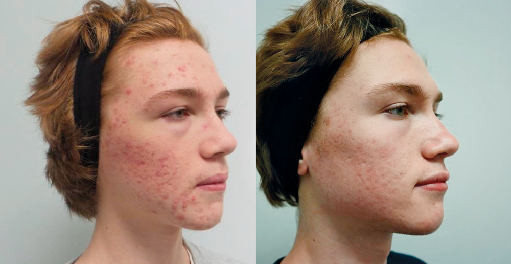 Acne patient before and after treatment with Infini, Excel V, and Spectra laser Aesthetic Clinique
