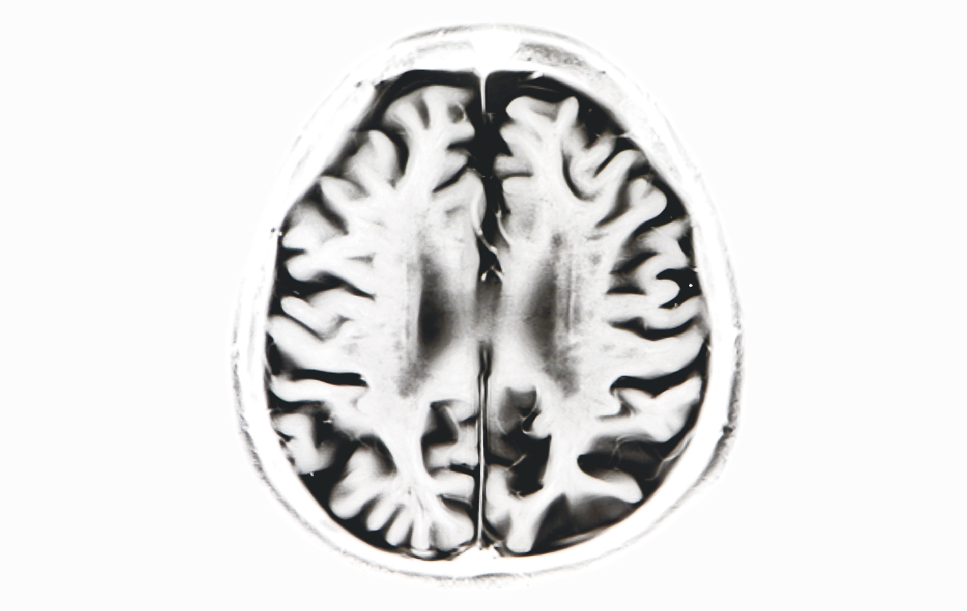 Decaying brain scan, alzheimer's